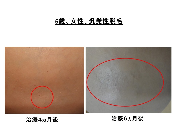 円形脱毛症　病院